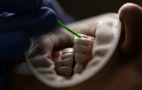 Top 3 avantaje ale fațetelor dentare