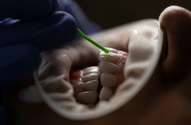 Top 3 avantaje ale fațetelor dentare 