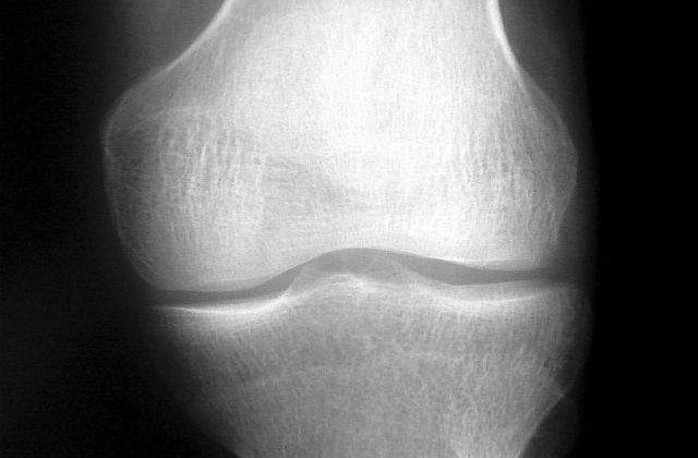 Studiu: Durerile de genunchi ar putea fi ereditare