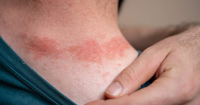 De ce sunt bărbații mai vulnerabili la psoriazis decât ai crede