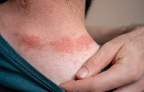 Află de ce bărbații sunt mai vulnerabili la psoriazis și infecții cu transmitere sexuală decât ai crede