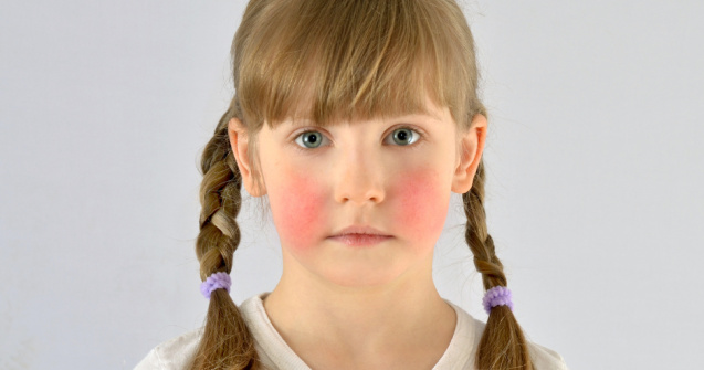 Ce este boala obrajilor pălmuiți cunoscută și ca eritemul infecțios