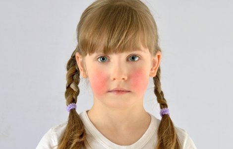 Boala obrajilor pălmuiți cunoscută și ca eritemul infecțios - Simptome, cauze și tratament