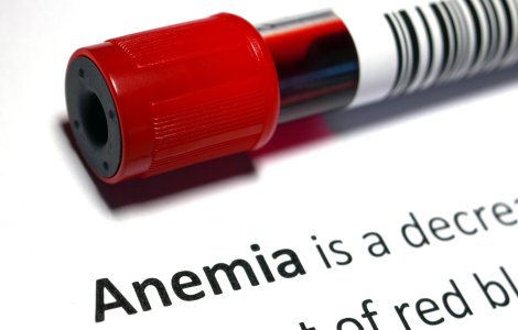 Simptomele anemiei - Cum se manifestă și când să mergi la medic
