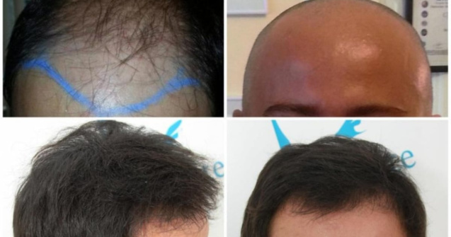 De ce există așa mare interes de a afla informații despre implantul de păr?