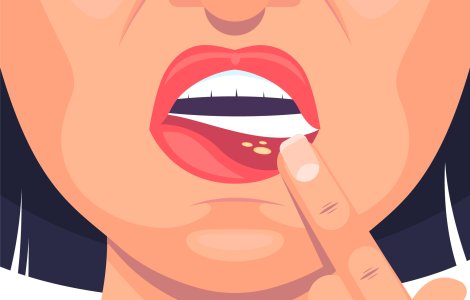 Leacuri bătrânești pentru afte - remedii naturale la care nu te astepti