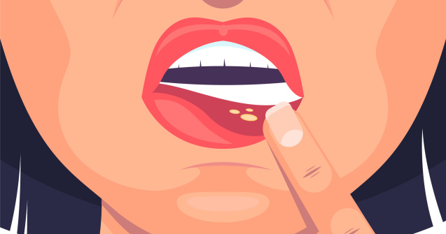 Leacuri bătrânești pentru afte - remedii naturale la care nu te astepti