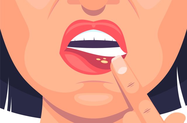 Leacuri bătr&acirc;nești pentru afte - remedii naturale la care nu te astepti