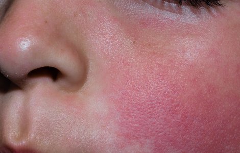 Adevărul șocant despre boala copilăriei care îți poate afecta copilul: Ce trebuie să știi despre boala obrajilor pălmuiți?