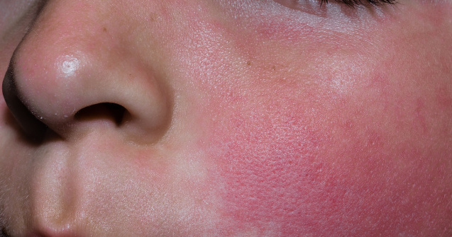 Adevărul șocant despre boala copilăriei care îți poate afecta copilul