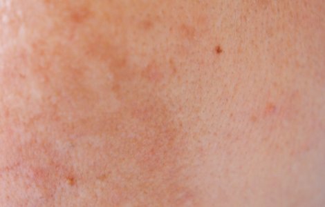 Adevărul ascuns despre bolile de piele și riscul de cancer!