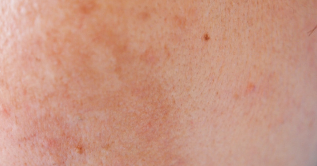 Adevărul ascuns despre bolile de piele și riscul de cancer!