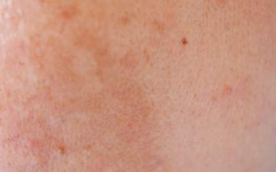 Descoperă bolile...