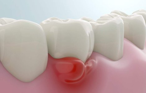 Descoperă afecțiunea dentară care îți poate pune sănătatea în pericol fără să știi