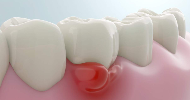 Află cum parodontita îți poate afecta sănătatea fără să știi!