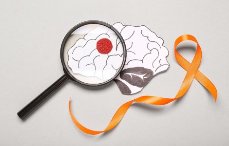 Descoperire revoluționară: Cum pot pacienții cu scleroză multiplă să-și îmbunătățească memoria și fluența verbală?