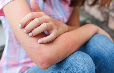 Descoperă metodele surprinzătoare de protecție împotriva țânțarilor și tratamentele naturale pentru mușcături