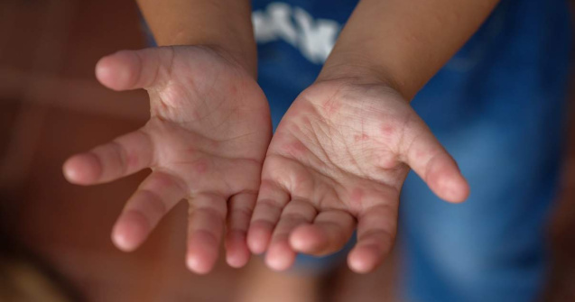 Herpangina la copii: simptome și pericole ascunse