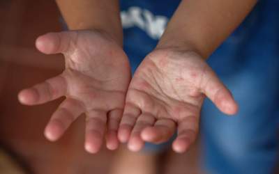 Secretele herpanginei la...