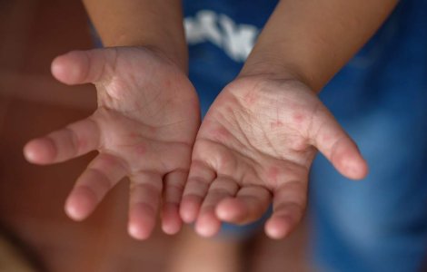 Herpangina la copii: simptome și pericole ascunse