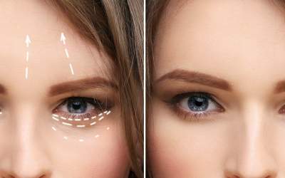 Ridicarea sprâncenelor: când...