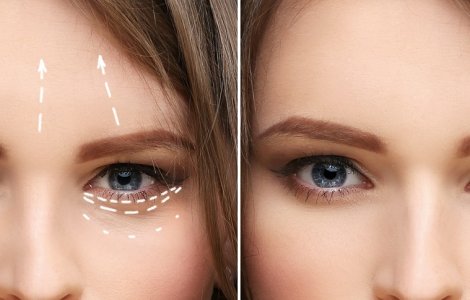 Ridicarea sprâncenelor: când este necesară și ce rezultate poți obține