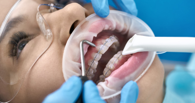 5 motive pentru a alege corectarea dinților cu aparate dentare și tratamente