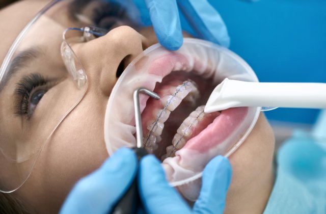 5 motive pentru a alege corectarea dinților cu aparate dentare și tratamente de estetică dentară &icirc;n București 