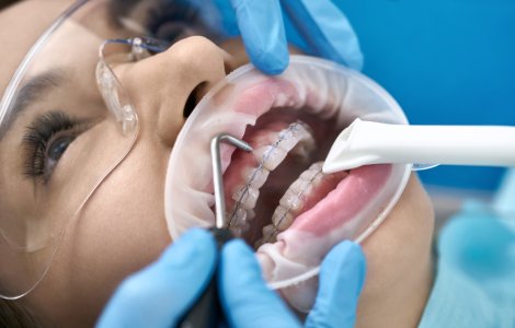 5 motive pentru a alege corectarea dinților cu aparate dentare și...