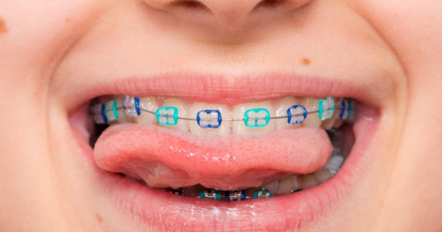 Aparatele dentare la copii: moft sau necesitate medicală?
