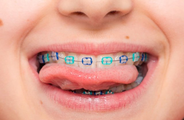 Aparatele dentare la copii: moft sau necesitate medicală? Ce spun studiile și practica ortodontică