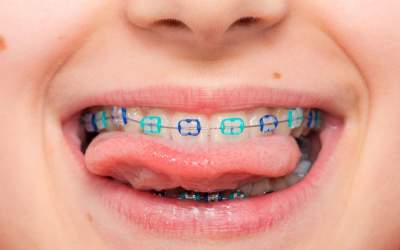 Aparatele dentare la copii:...