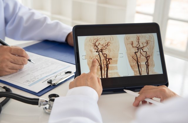 Ce afecțiuni poate depista angiografia cerebrală? 