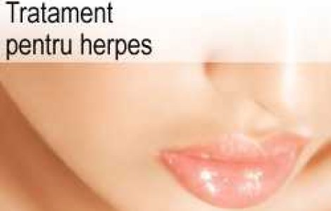 Tratament pentru herpes
