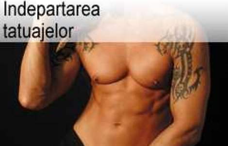 Indepartarea tatuajelor