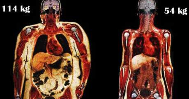 Corpuri scanate: O femeie de 114 kg vs. o femeie de 54 kg
