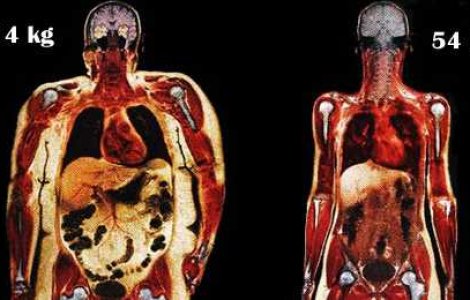 Corpuri scanate: O femeie de 114 kg vs. o femeie de 54 kg