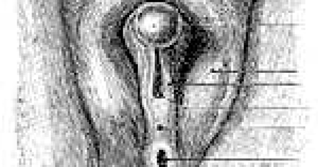 Stiati...cum se face transplantul de sex?