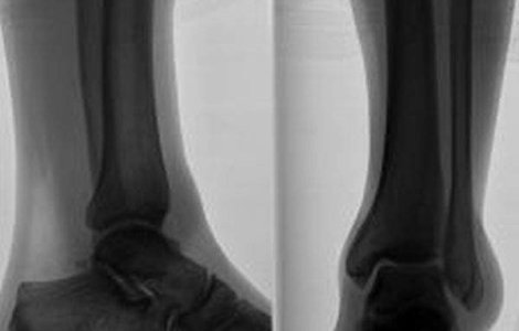 Studiu: Persoanele cu membre amputate pot sa isi miste protezele bionice prin puterea gandului