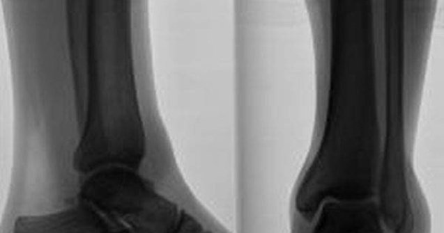 Studiu: Persoanele cu membre amputate pot sa isi miste protezele bionice prin puterea gandului