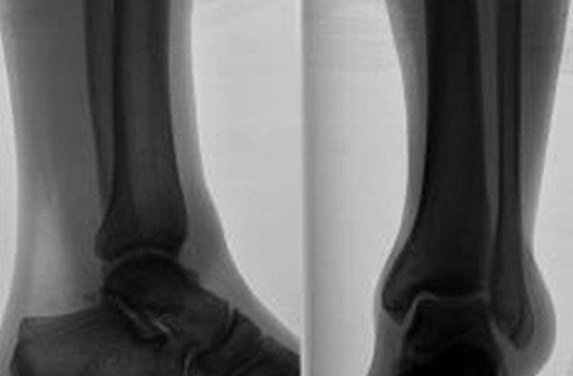 Studiu: Persoanele cu membre amputate pot sa isi miste protezele bionice prin puterea gandului