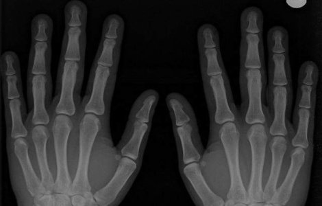 Concursul Infomatrix: Eleve medaliate cu aur pentru un proiect de reabilitare medicala a mainii