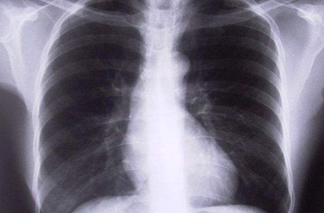 Sunt mai DAUNATOARE decat credeai! Alimente periculoase pentru plamani