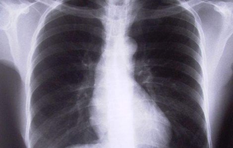 Studiu: Misterul cazurilor rare de plamani "sanatosi" ai fumatorilor in varsta, descifrat