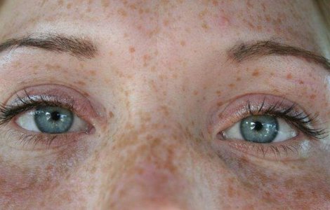 Cele mai EFICIENTE moduri de a scapa de petele maronii de pe piele