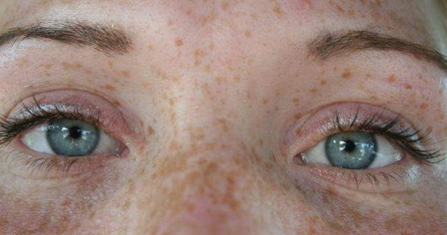 Cele mai EFICIENTE moduri de a scapa de petele maronii de pe piele