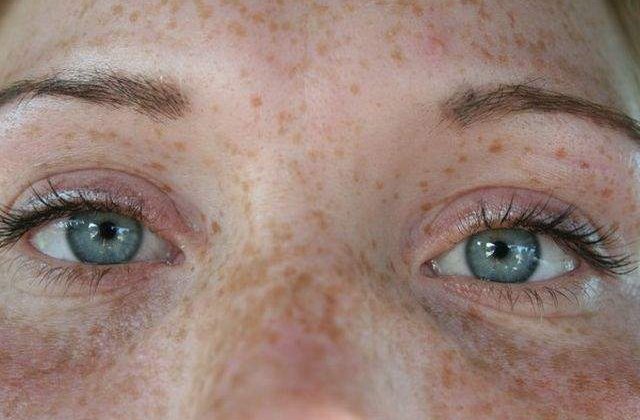 Cele mai EFICIENTE moduri de a scapa de petele maronii de pe piele