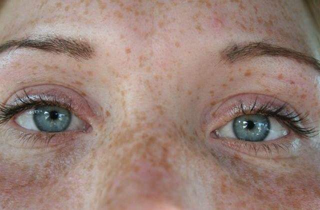 Cele mai EFICIENTE moduri de a scapa de petele maronii de pe piele