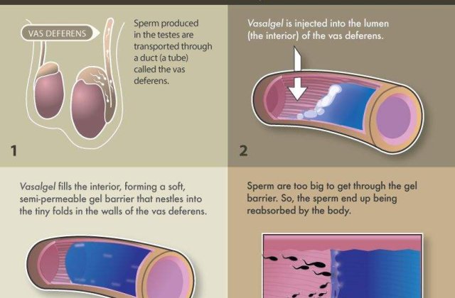 Spuneti adio prezervativului si anticonceptionalelor! Hidrogelul este cea mai sigura si moderna metoda
