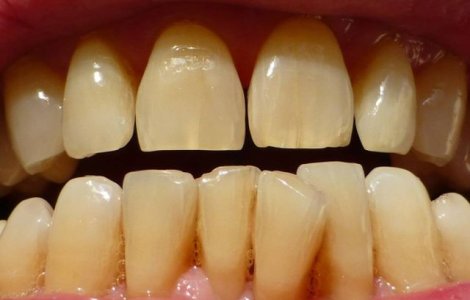  Top  4 efecte negative ale "dintilor strambi" asupra sanatatii